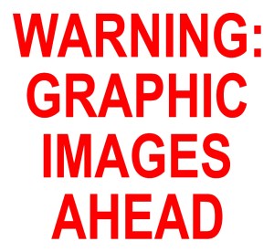 AHummelAbortionPicture